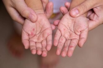 Hand, Foot and Mouth Disease Cases Rise Across Japan